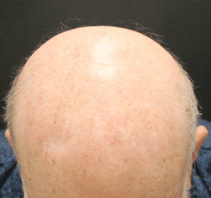 After 3 KTP post head