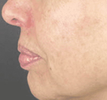 After Skin Resurfacing
