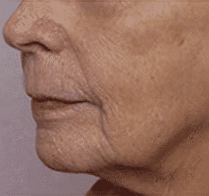 After Skin Tightening
