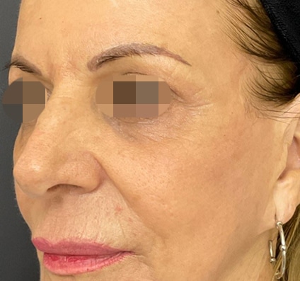 After winter reset treatment Courtesy of Dr. Bermejo, Bermejo Clinic, Argentina
