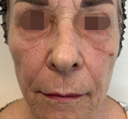 After winter reset treatment | Courtesy of Dr. Pina Panchal