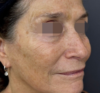 Before Winter reset treatment | Courtesy of Dr. Bermejo, Bermejo Clinic, Argentina