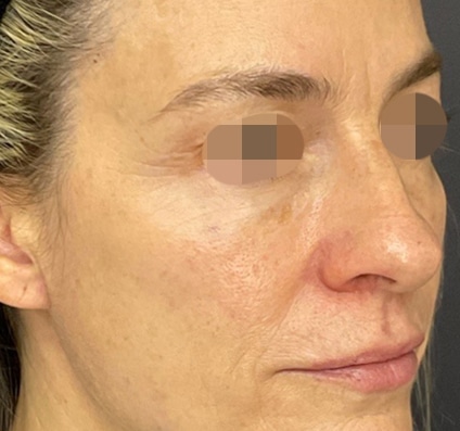 Before winter reset treatment Courtesy of Dr. Bermejo, Bermejo Clinic, Argentina