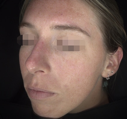After Pixel Peel treatment