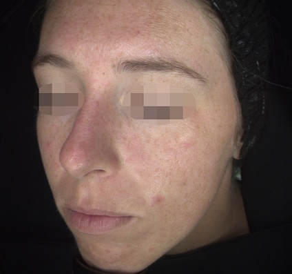 Before Pixel Peel treatment Courtesy of Alma’s Clinical Department