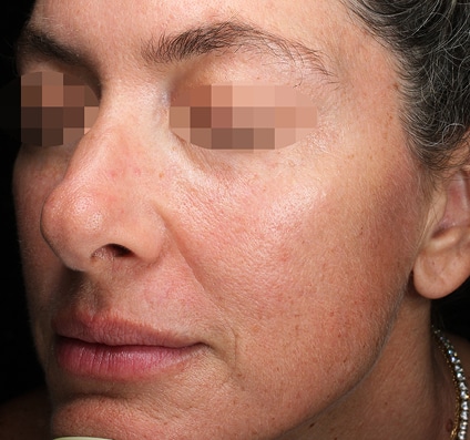 Before Pixel Peel treatment Courtesy of Prof. Ofir Artzi