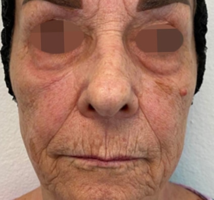 Courtesy of Dr. Pina Panchal Before winter reset treatment