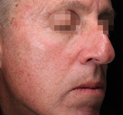 Before Winter Reset treatment
